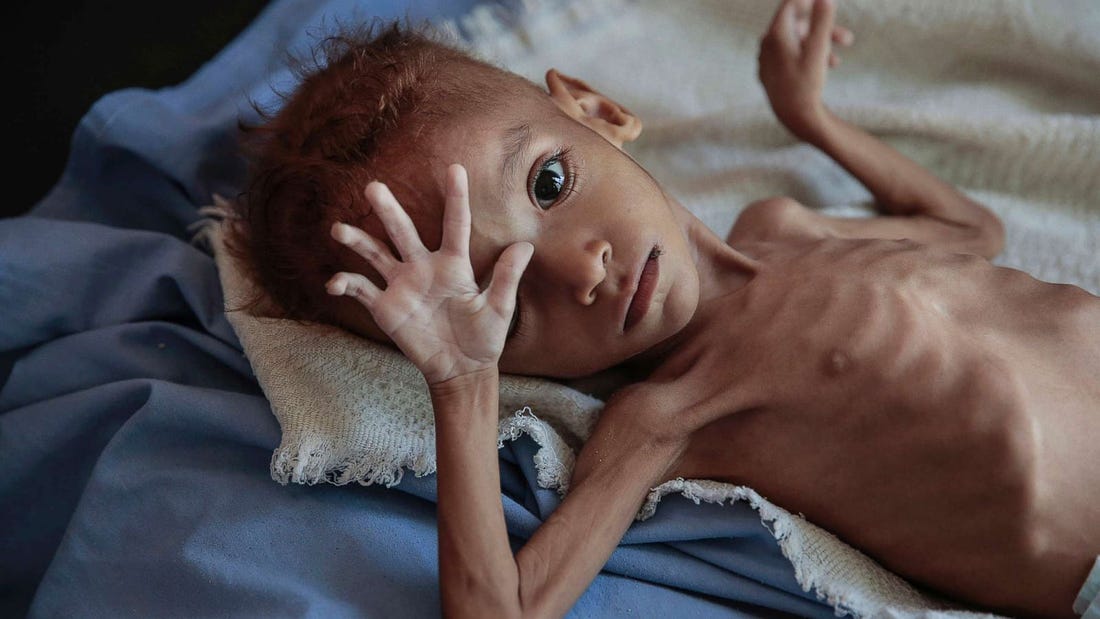 85,000 children in Yemen have starved to death: Save the Children report -  ABC News