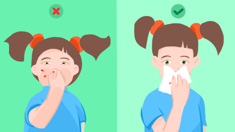 How to Stop Your Child&#39;s Nosebleed on Your Own