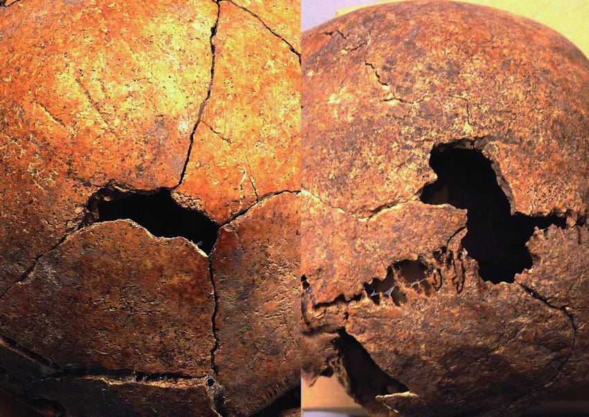 Type I fractures, skulls No. 4, 9. Type I fractures, skulls No. 4, 9.